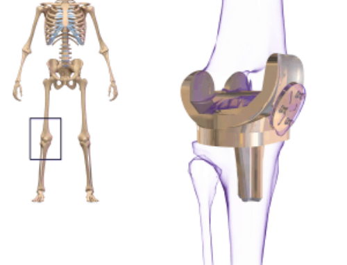 Benefits and Risks of Total Knee Replacement Surgery