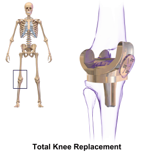 Joint replacement photo of knee surgery skeleton